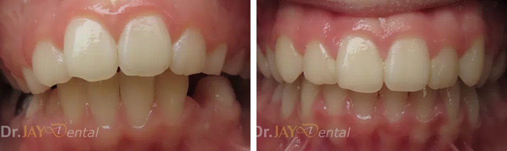 Before and after ceramic implant case
