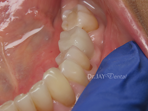 Case 1 after ceramic dental implant treatment