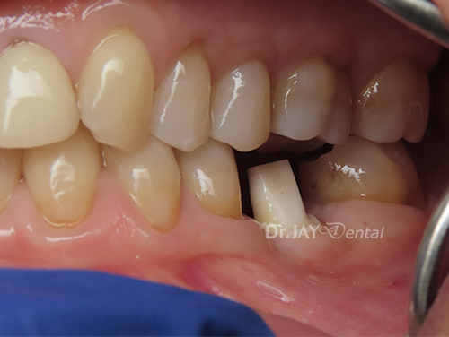 Case 1 before ceramic dental implant treatment