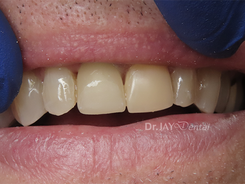 Case 2 after ceramic dental implant treatment