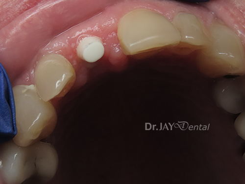 Case 2 before ceramic dental implant treatment