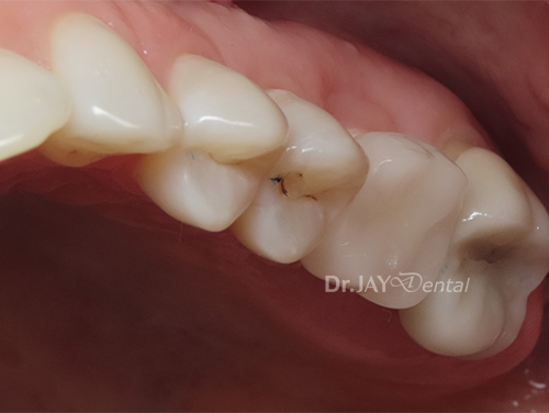 Case 3 after ceramic dental implant treatment