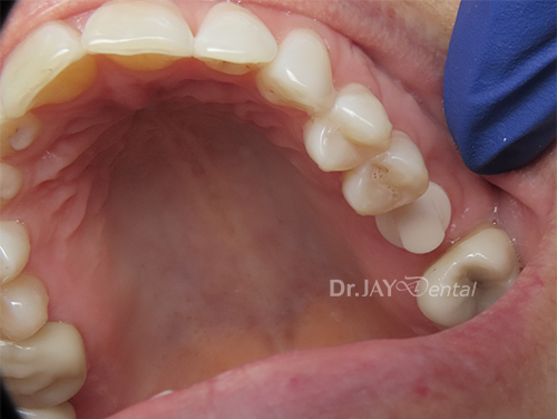 Case 3 before ceramic dental implant treatment
