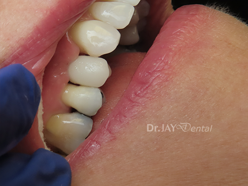 Case 8 after ceramic dental implant treatment