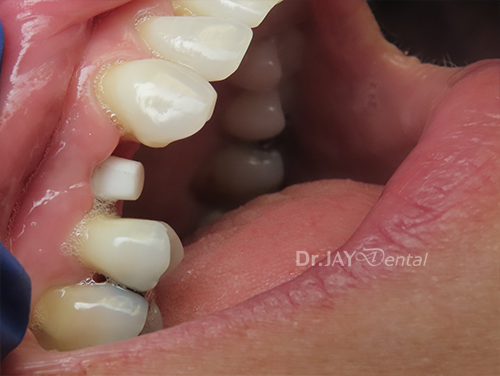 Case 8 before ceramic dental implant treatment