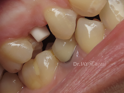 Case 10 before ceramic dental implant treatment