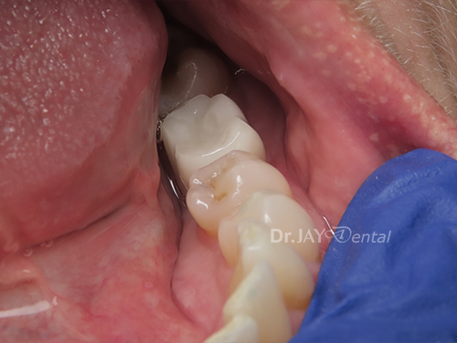 Molar site after ceramic dental implant treatment