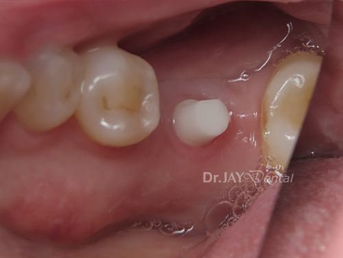Molar site before ceramic dental implant treatment