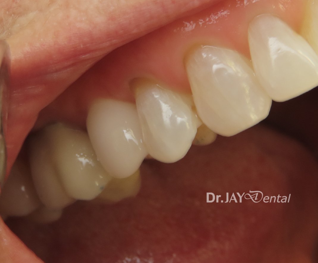 Case 13 after ceramic dental implant treatment