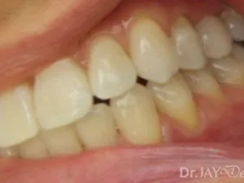 Case 14 ceramic dental implant treatment
