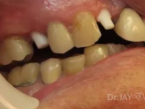 Case 15 ceramic dental implant treatment