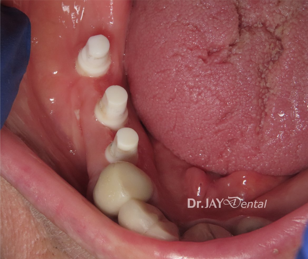 Case 5 ceramic dental implant treatment