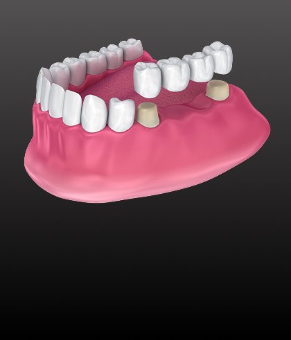 Digitally planned dental restoration